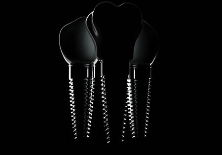 JUcpBk-dentalImplant