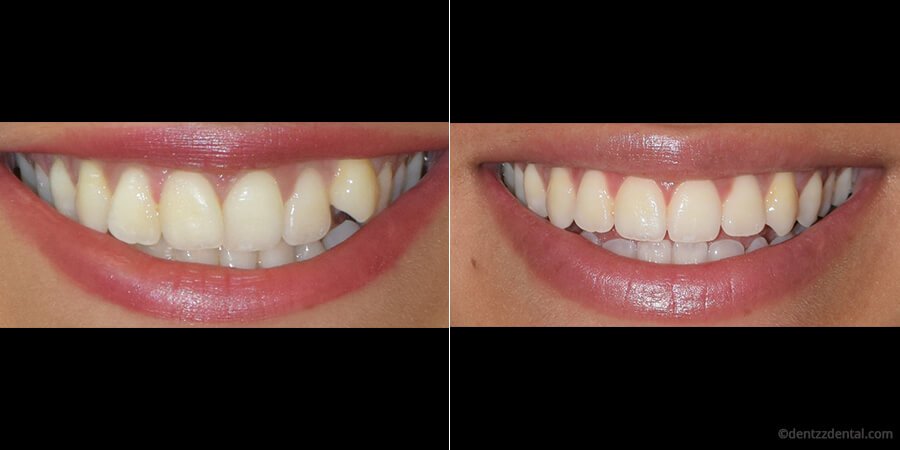 lsfvJc-yWuESy-Invisible-braces-and-Invisalign-before-after---900-x-450px (1)